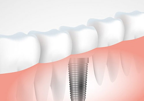 dental-Implants